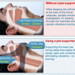 Snoring Chin Strap Effectiveness – Does It Work?