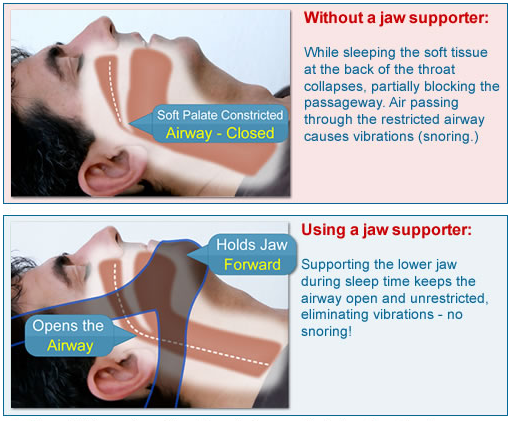 How The Snoring Chin Strap Works